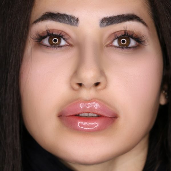 تزریق ژل لب