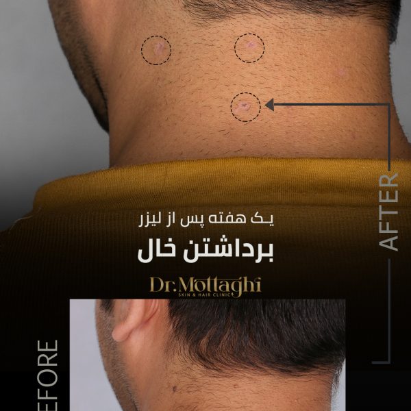 لیزر co2 fractional در شیراز