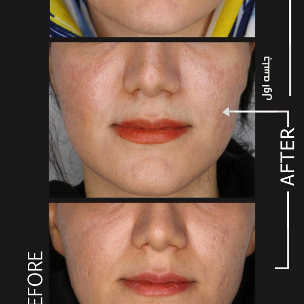 لیزر co2 fractional در شیراز