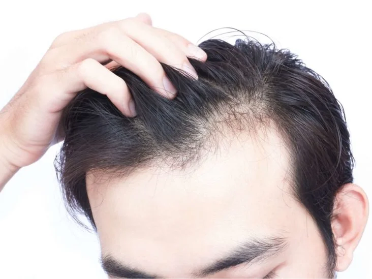 آیا کمبود آهن باعث ریزش مو می شود؟