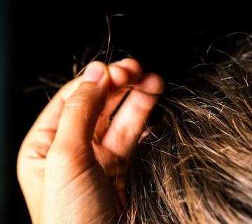  ریزش مو در افراد مبتلا به تریکوتیلومانیا