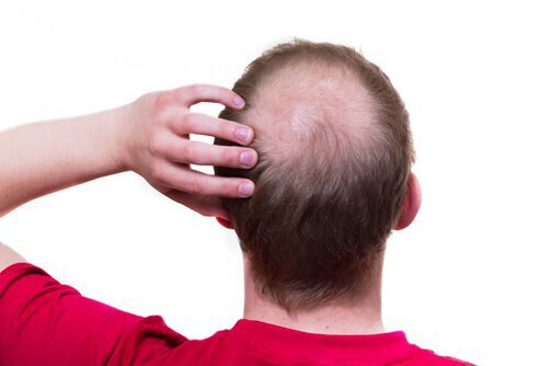ریزش مو در افراد مبتلا به تریکوتیلومانیا