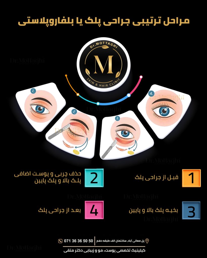 مراحل ترتیبی جراحی پلک یا بلفروپلاستی