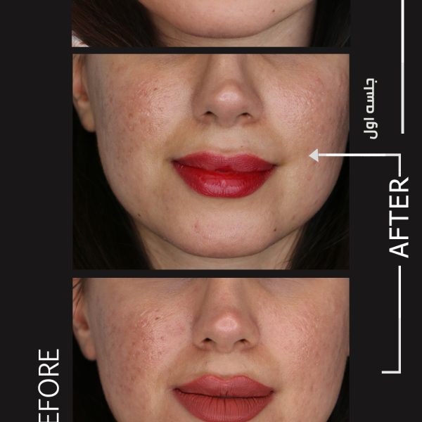 لیزر co2 fractional در شیراز