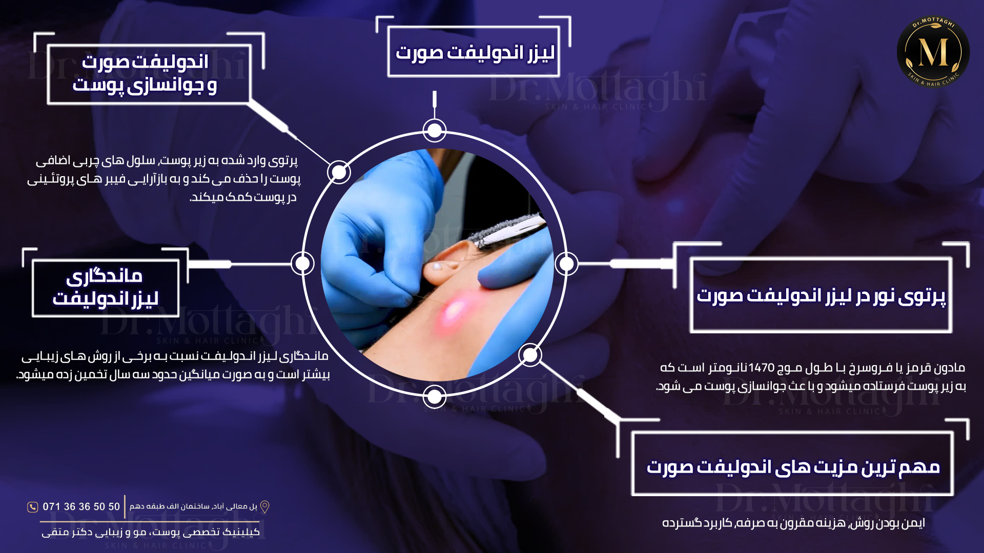 لیزر اندولیفت صورت