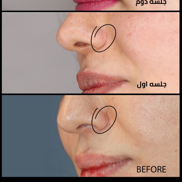 لیزر co2 fractional در شیراز