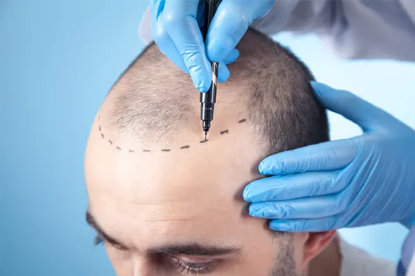 همه چیز درباره کاشت مو