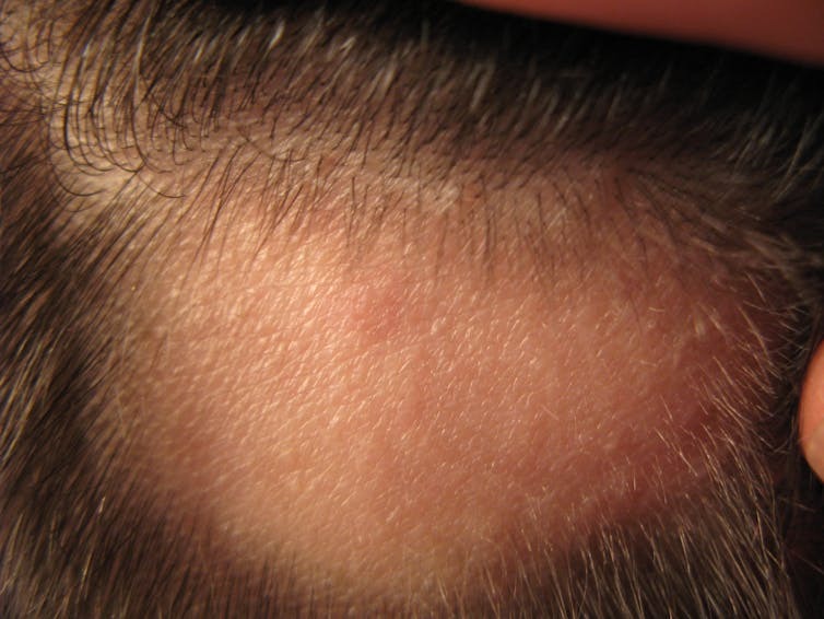 طاسی منطقه‌ای یا آلوپسیا آرآتا (Alopecia areata)