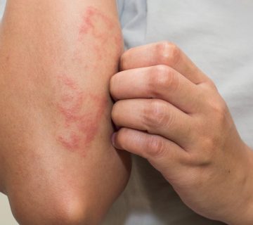 سفید کننده حمام درمانی موثر برای اگزما